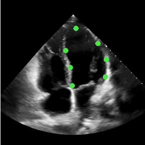 Medical Automatic Image Left Ventricle Segmentation